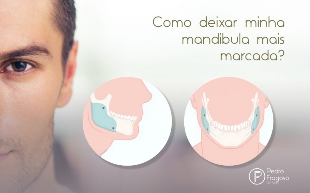 Preenchimento mandibular e implante prototipado. Entenda os procedimentos -  Dr. Pedro Fragoso