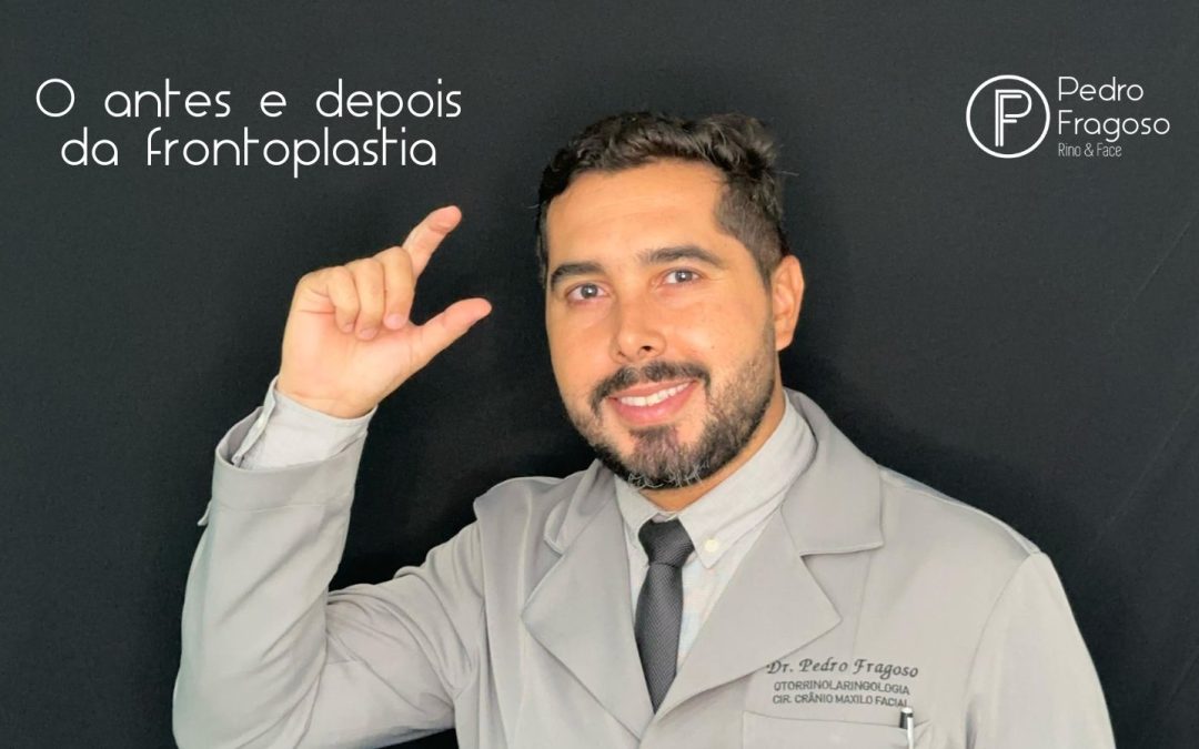 frontoplastia antes e depois Dr. Pedro Fragoso