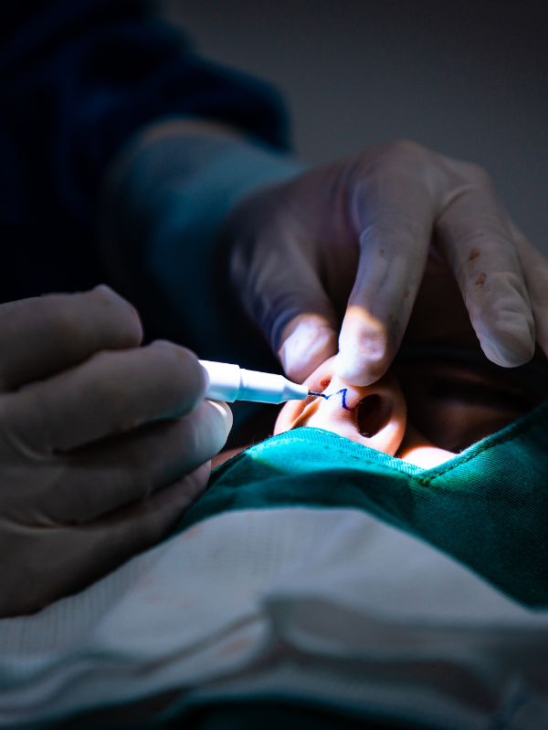 Pedro Fragoso Cirurgia de Redução de Testa em Goiânia otorrino cirurgião facial rinoplastia<br />
